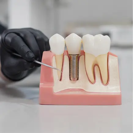 Modelo odontológico para planejamento de implante dentário